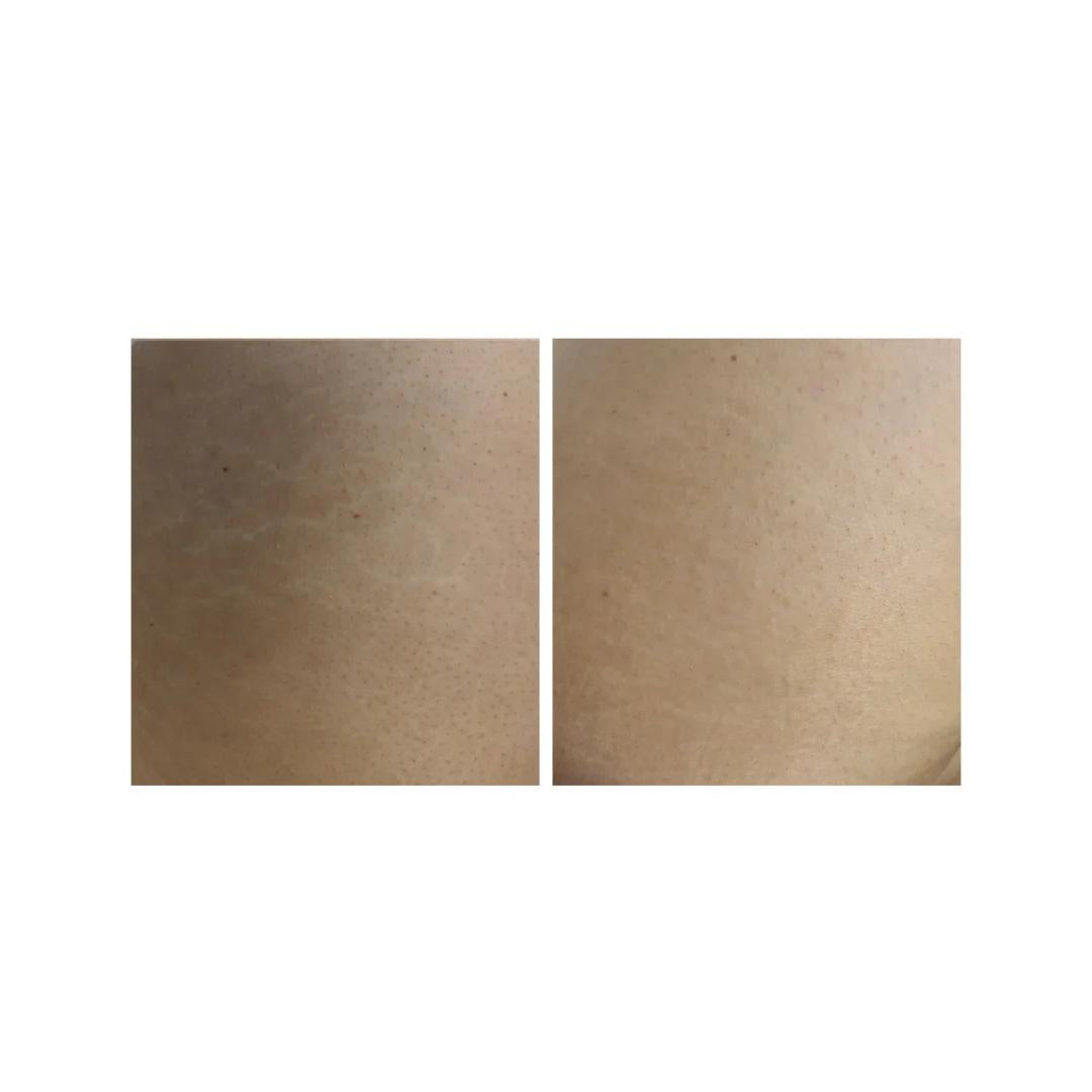 Crema Corpo Smagliature e Cicatrici