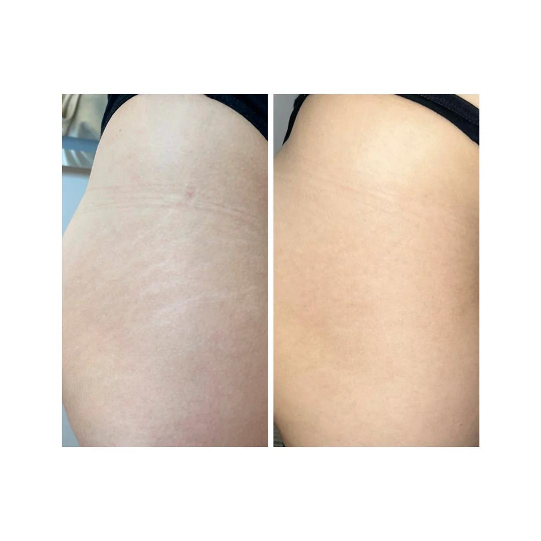 Goldenoil Siero Anti Smagliature