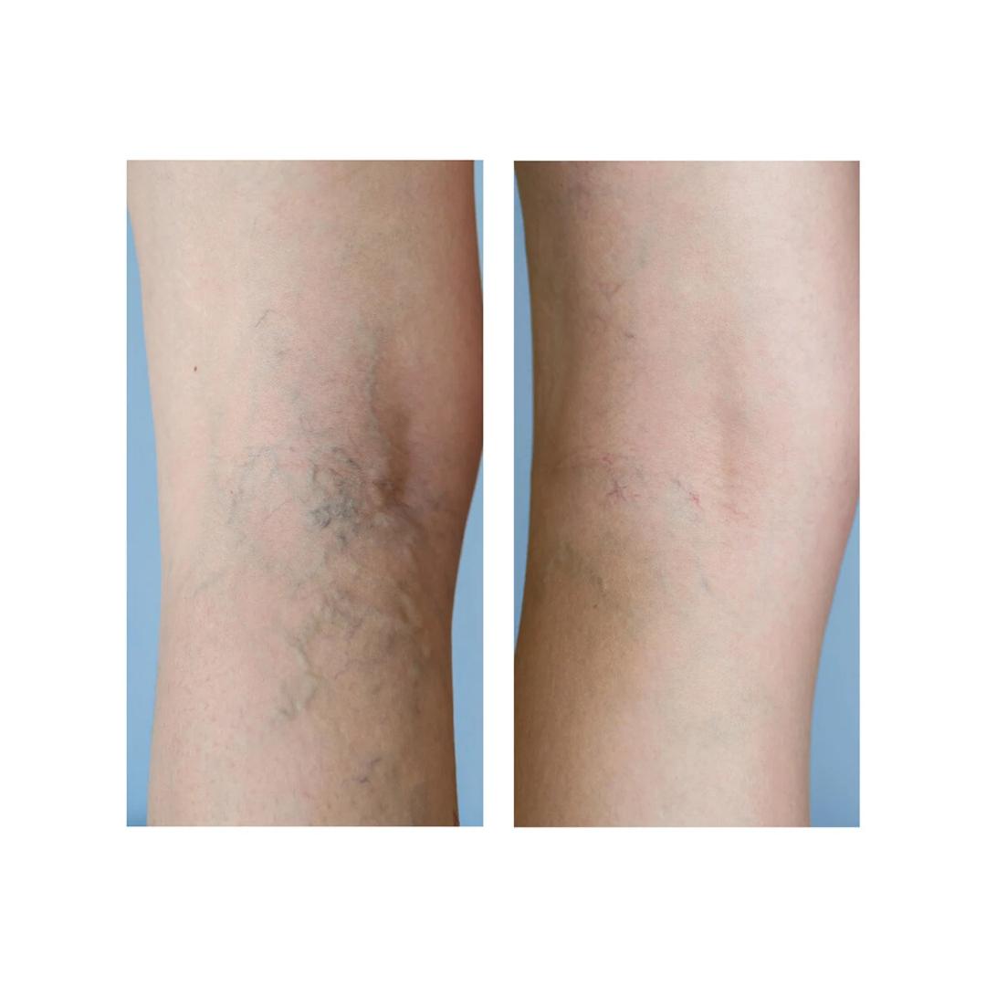 Crema Vene Varicose e Capillari